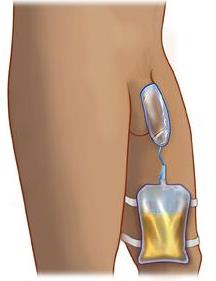 Male External Catheters